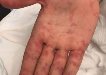 Sëmundja që po prek fëmijët, Mjeku Tritan Kalo apel prindërve: “Përhapet nga kontakti me të infektuarit, bëni kujdes”