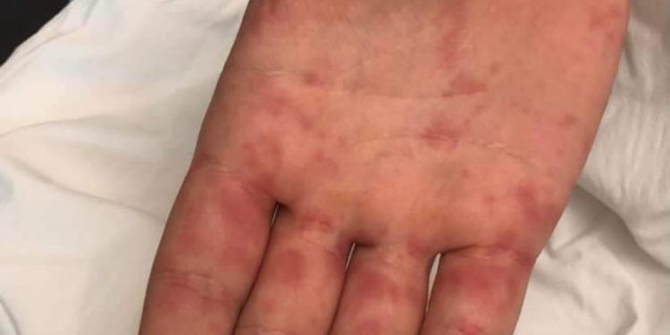 Sëmundja që po prek fëmijët, Mjeku Tritan Kalo apel prindërve: “Përhapet nga kontakti me të infektuarit, bëni kujdes”