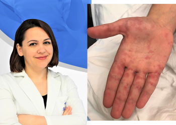 Virusi gojë-këmbë-dorë që po qarkullon aktualisht tek fëmijët/  Çfarë duhet të kenë kujdes prindërit? Pediatrja Ilsa Mula Kraja shpjegon