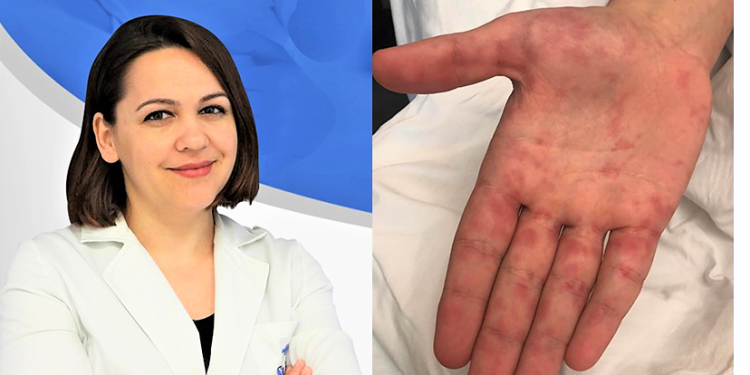 Virusi gojë-këmbë-dorë që po qarkullon aktualisht tek fëmijët/  Çfarë duhet të kenë kujdes prindërit? Pediatrja Ilsa Mula Kraja shpjegon