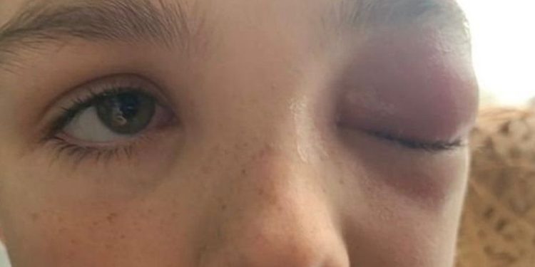 Rrezikon verbimin nga infeksioni në sy. 9 vjeçari po kalonte Covid-19