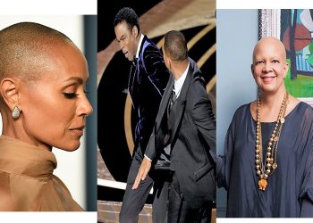 Alopecia, sëmundja që u bë motiv grushti në Oskar/ Çfarë është dhe nga se shkaktohet?