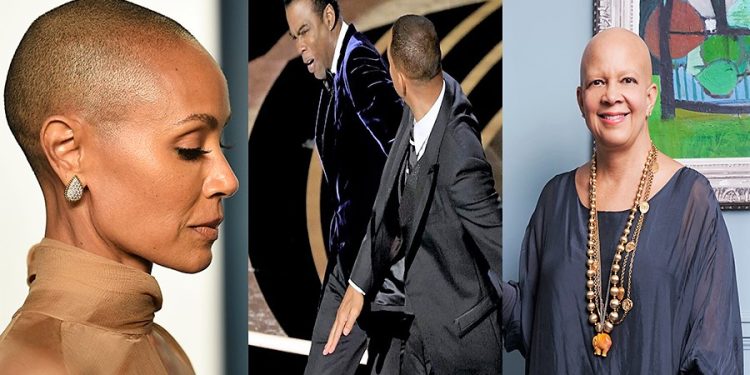 Alopecia, sëmundja që u bë motiv grushti në Oskar/ Çfarë është dhe nga se shkaktohet?