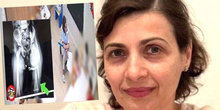 Deklarata e paprecedentë e edukatores që i theu këmbën  3 vjeçares: “I rashë me vizore që të kishte mendjen”