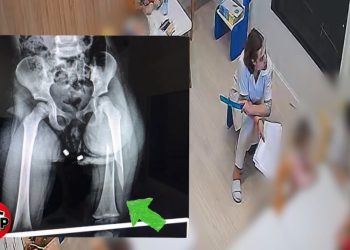 Krimi në kopshtin “Stinët” në Tiranë/ Edukatorja i thyen këmbën 3 vjeçares,  prindërit  njoftohen pesë orë më pas