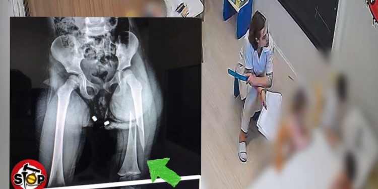 Krimi në kopshtin “Stinët” në Tiranë/ Edukatorja i thyen këmbën 3 vjeçares,  prindërit  njoftohen pesë orë më pas