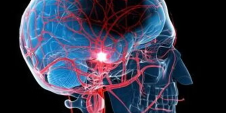 Studimi/ Rriten me 70% goditjet në tru. Fajtorë smogu, mbipesha dhe duhani